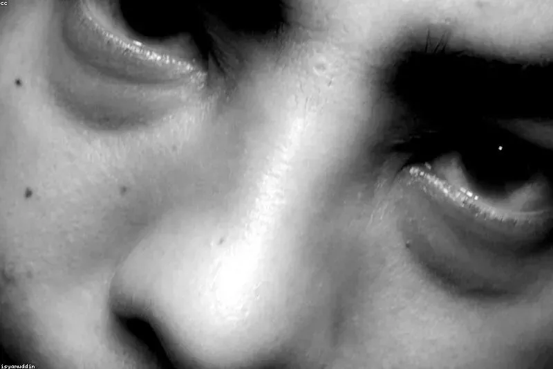 Natural remedies for blepharitis with warm compresses and chamomile