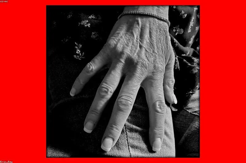 Natural remedies for Dupuytren's contracture with massage and castor oil