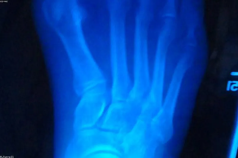 Remedii naturale și alimentație pentru susținerea în boala Paget osoasă