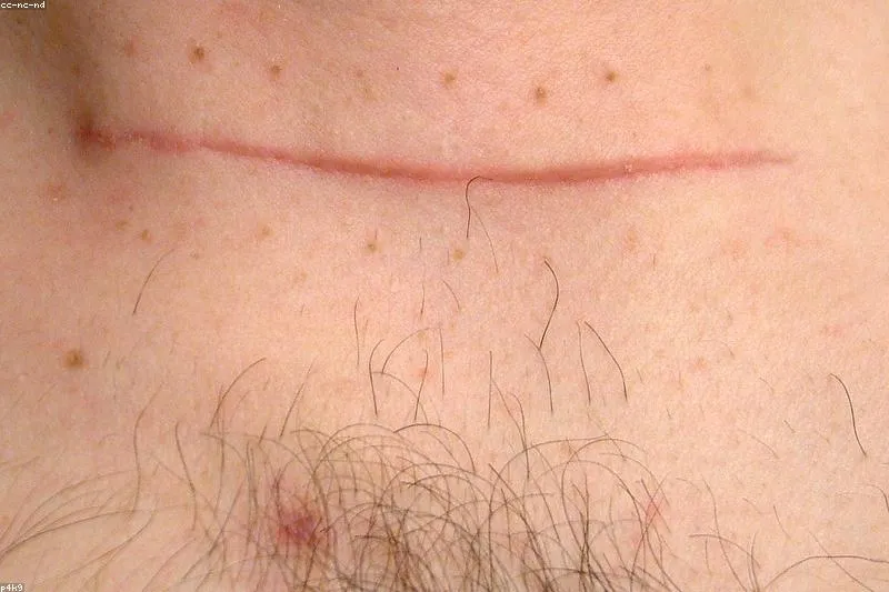 Natural remedies for hyperthyroidism with lemon balm, bugleweed, and valerian