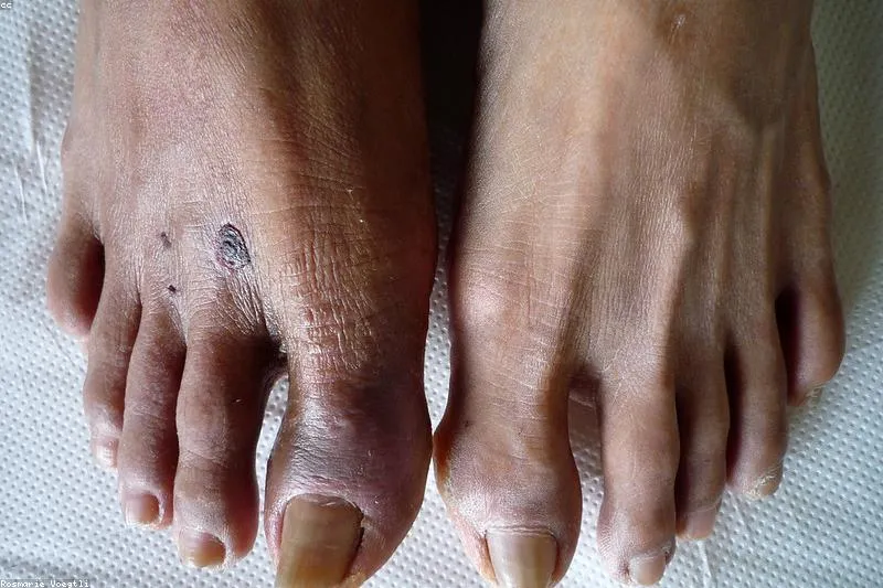 Peripheral ischemia: what it is and how to control it