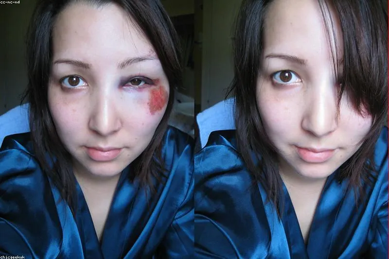 Natural remedies for mumps: warm compresses, chamomile, propolis, and teas