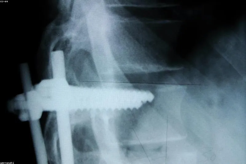 Natural remedies and exercises for osteochondrosis and spine pain