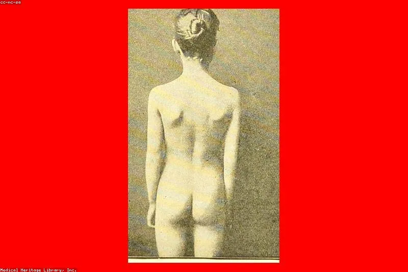 Exercises and support methods for scoliosis, the laterally curved spine