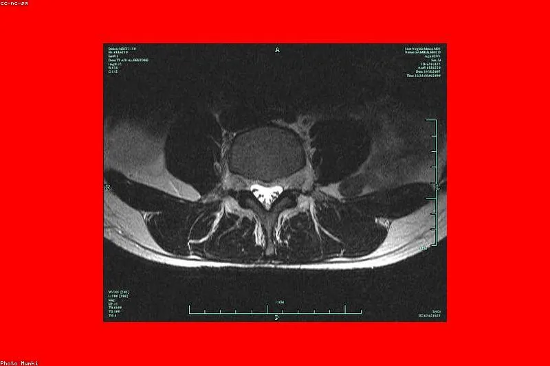 Natural support for patients with ankylosing spondylitis