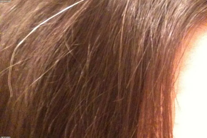 Trichotillomania: natural remedies and therapy support